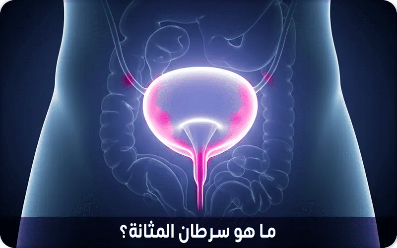 ما هو سرطان المثانة؟