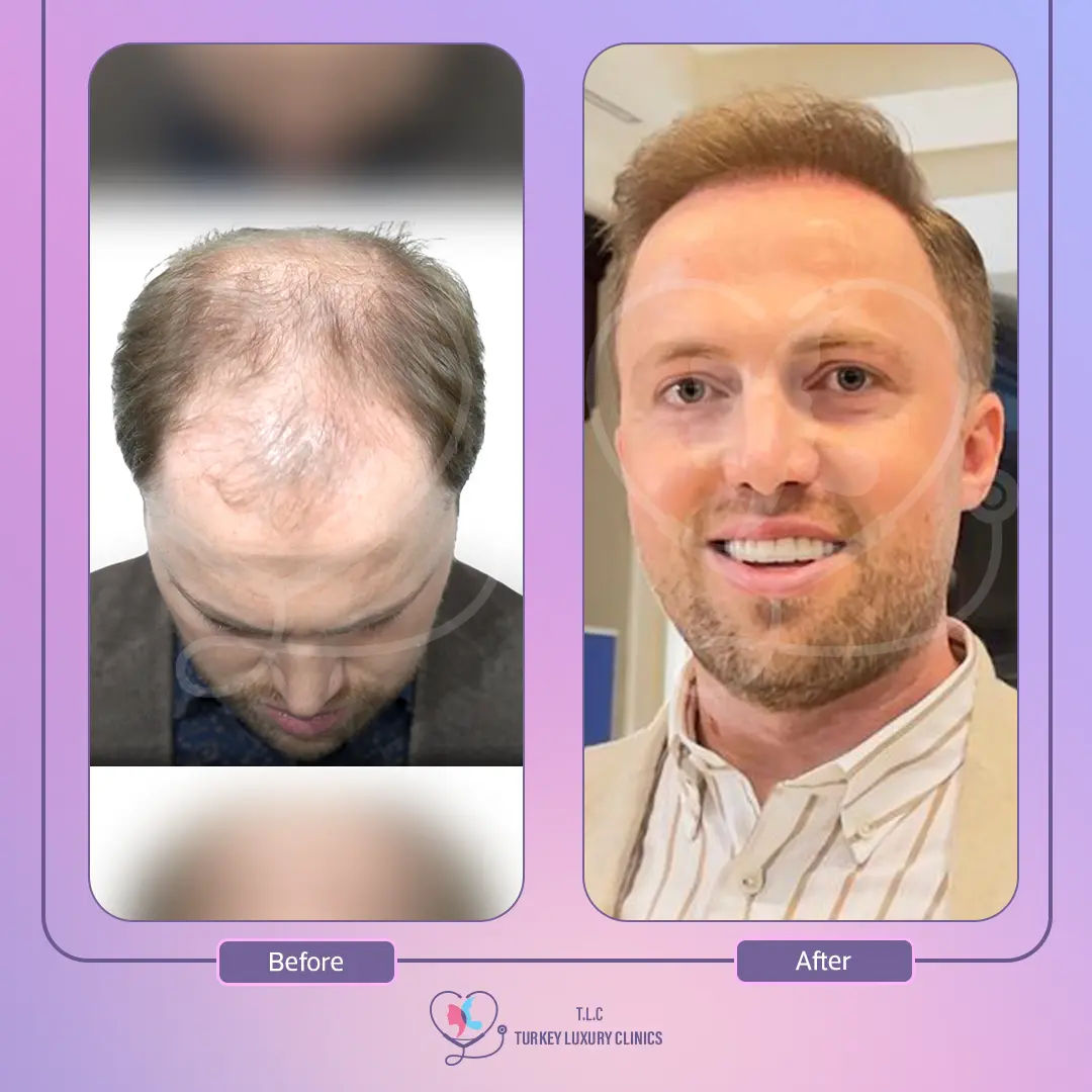 تجربة زراعة الشعر في تركيا لاكشري كلينك