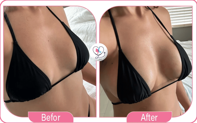 Lipofilling mammaire avis 2016 à 2024