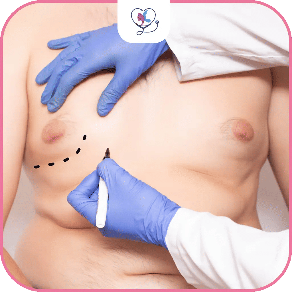 عملية التثدي عند الرجال في تركيا