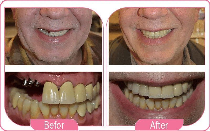 Front Tooth Dental Implant