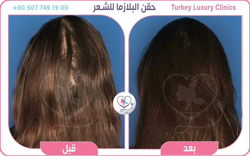 حقن البلازما للشعر قبل وبعد