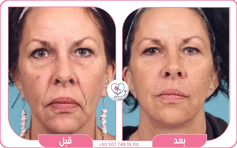 تكلفة عملية شد الوجه في سوريا