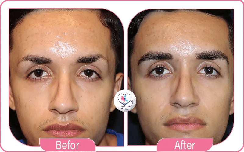 Men's Eyebrow Transplant Before and After