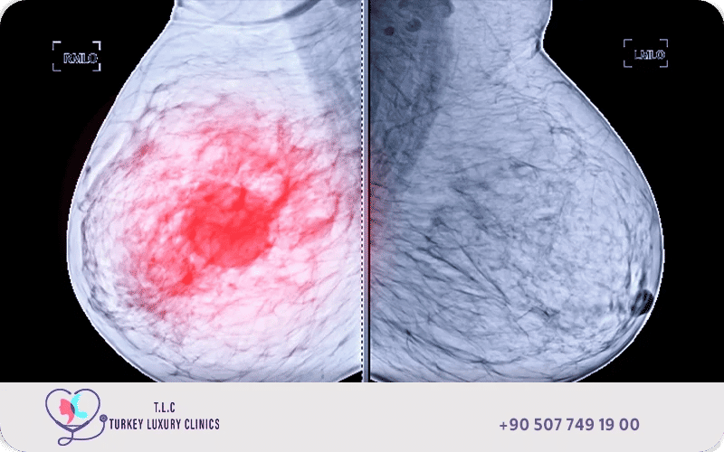 الفرق بين ورم الثدي الخبيث والحميد