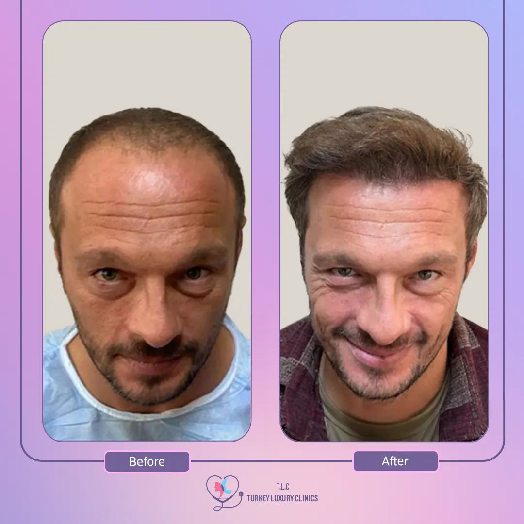 ماهي زراعة الشعر بالاقتطاف FUE في تركيا؟