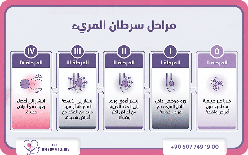 مراحل سرطان المريء