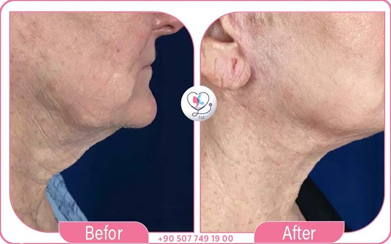 تكلفة عملية شد الرقبة: تركيا والسعودية وباقي الدول-1772048335202