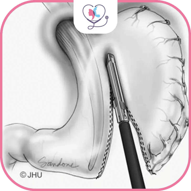 Laparoscopic Gastric Sleeve Surgery