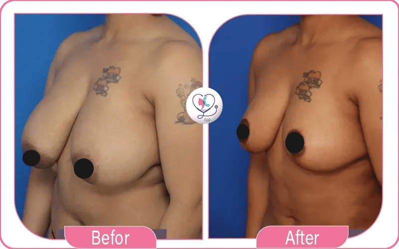 Breast Reduction C Cup Results