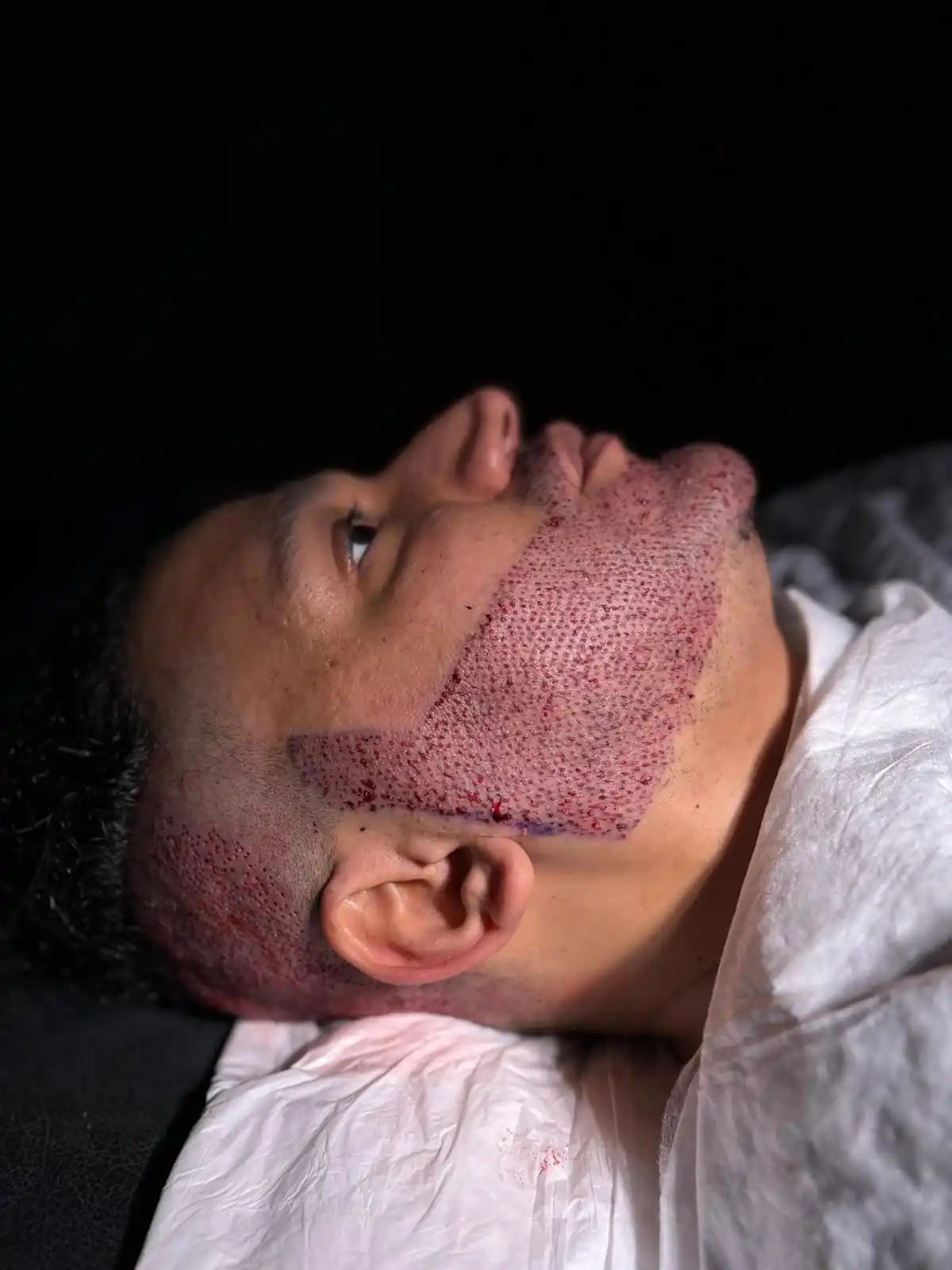 خطوات زراعة اللحية في تركيا