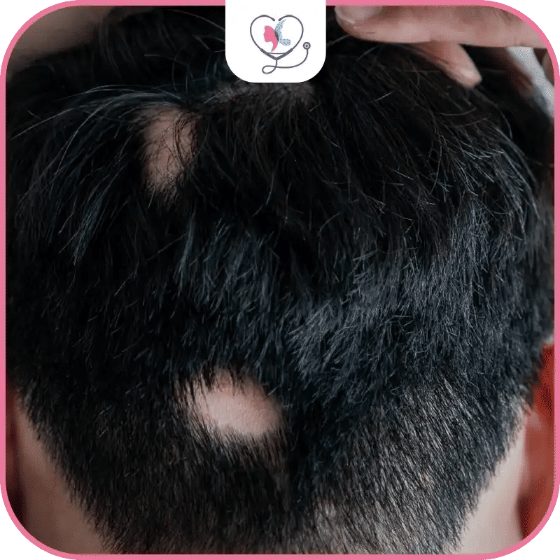 La pelade (Alopecia Areata) : Guide complet