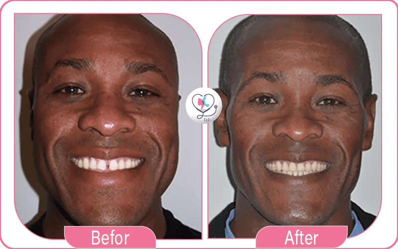 نصائح من تجربتي مع تقويم الأسنان لدى تركيا لاكشري كلينك