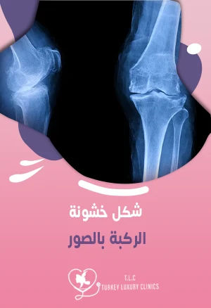 شكل خشونة الركبة بالصور: فيديو يشرح التفاصيل والتشخيصfeatured image