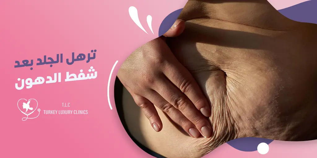 ترهل الجلد بعد شفط الدهون