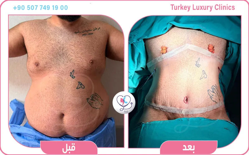 عملية شد البطن
