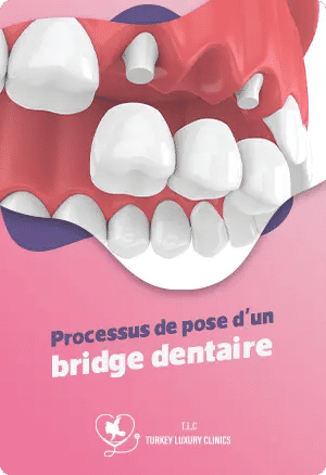 Processus de pose d'un bridge dentaire