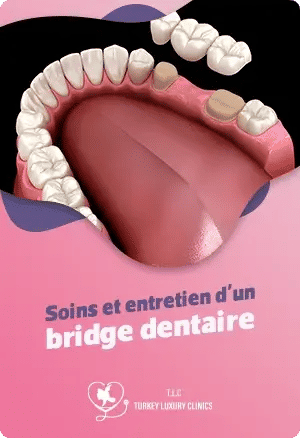 Soins et entretien d'un bridge dentairefeatured image