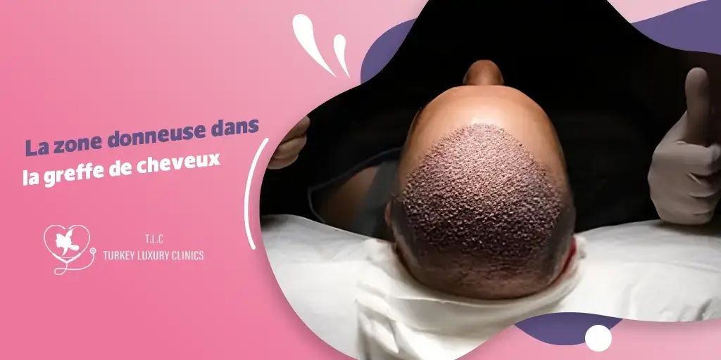 La zone donneuse dans la greffe de cheveux