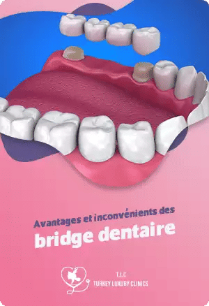 Avantages et inconvénients des bridges dentaires