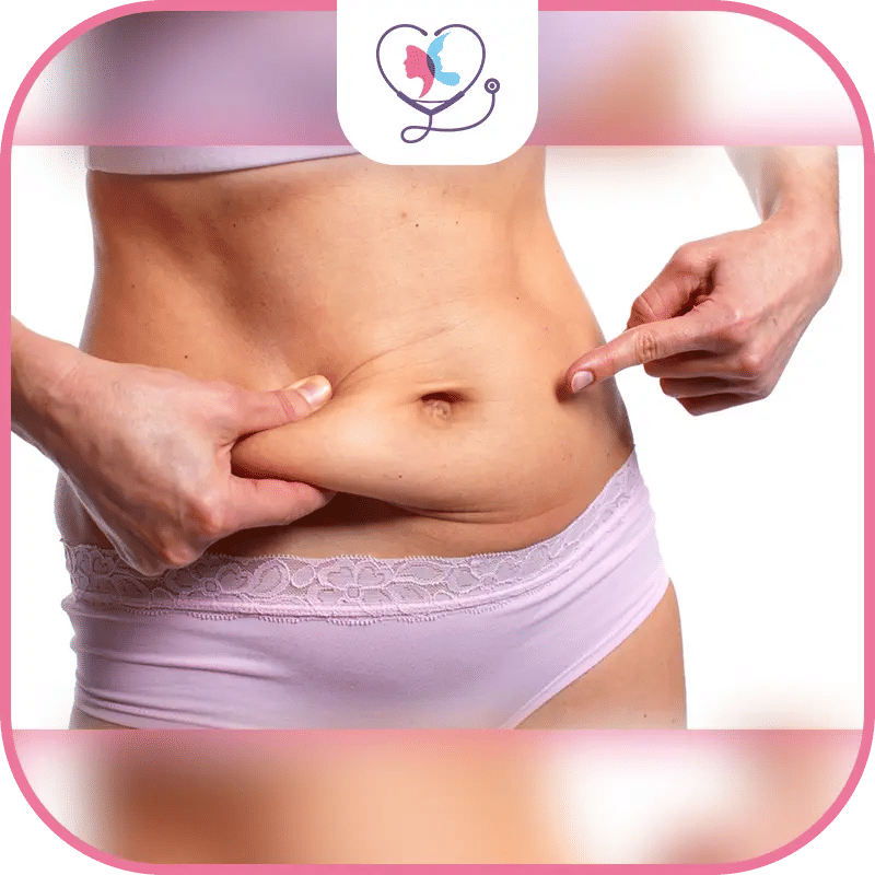 عملية شد البطن بعد تكميم المعدة