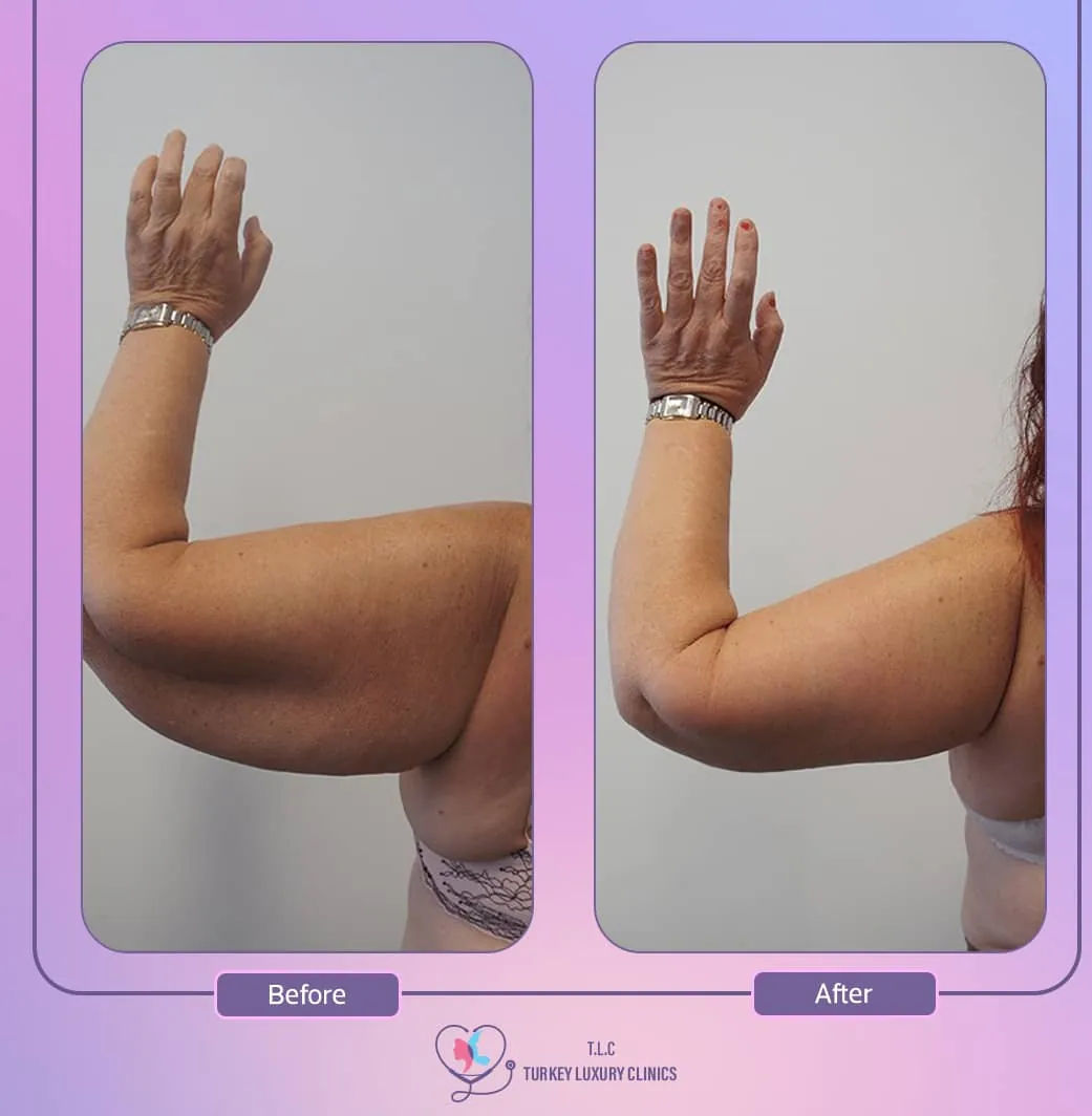 كيف كانت تجربتي مع ترهلات الذراعين قبل العملية؟