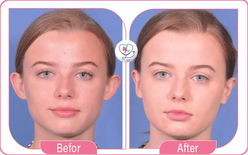 Incisionless Otoplasty Before and After