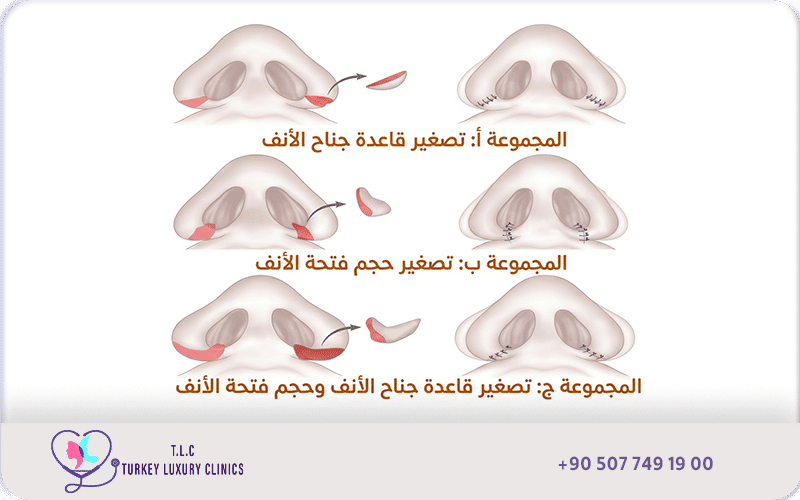 عملية تصغير فتحات الانف