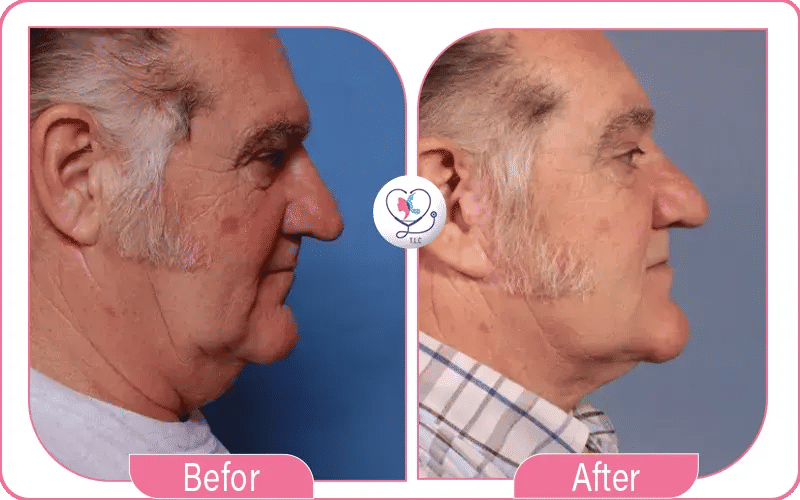 Total Mini Neck Lift Cost Breakdown