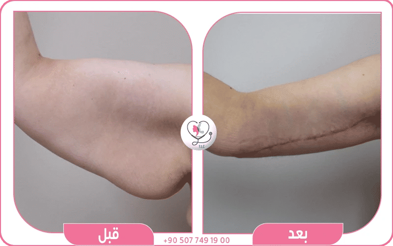 كيف تمت العملية خطوة بخطوة؟