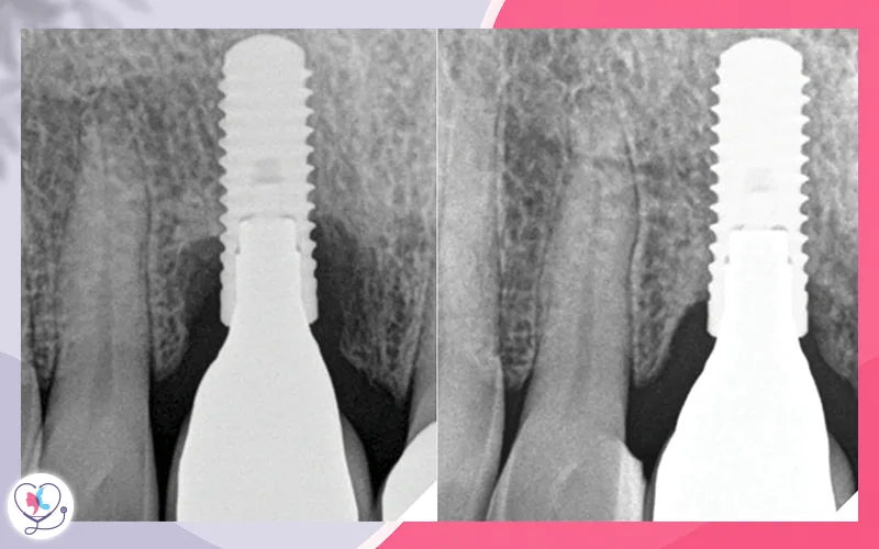 Peri-Implantitis