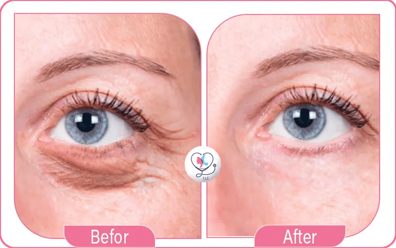 Photos de blépharoplastie avant après