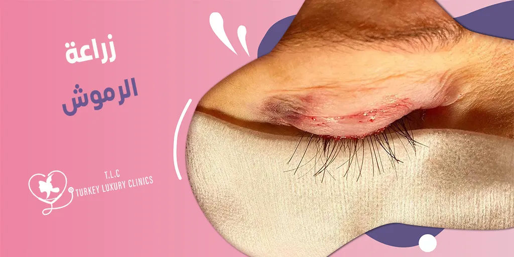 زراعة الرموش: الخطوات والنتائج بالصور والتكلفة في تركيا