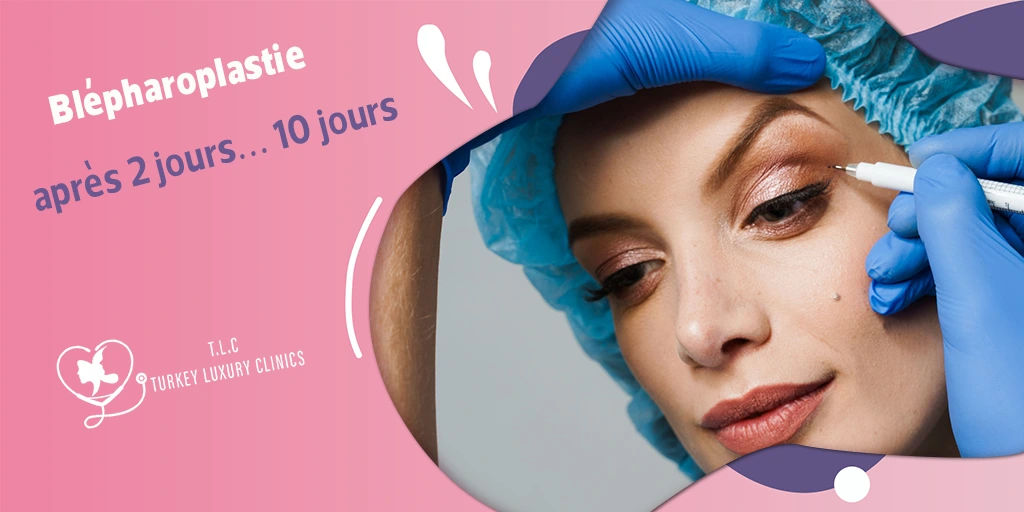 Blépharoplastie après 2 jours, 3 jours, 5 jours, 7 jours, 10 jours