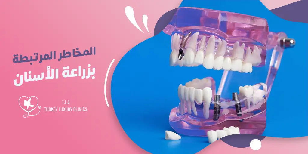 ماهي مخاطر زراعة الأسنان؟