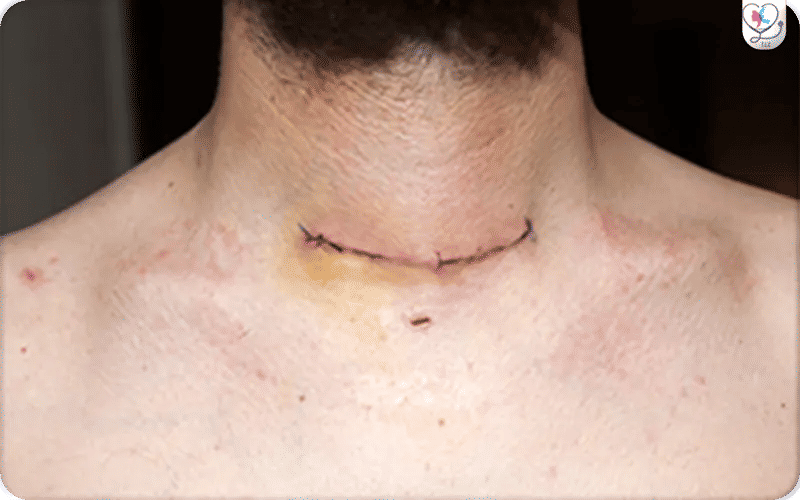 هل يوجد احتمالات رجوع ورم الغدة الدرقية بعد الاستئصال؟