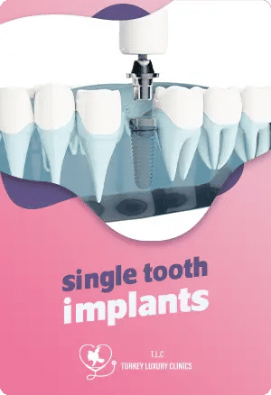 Single Tooth Implants: Restoring a Single Tooth Naturally and Permanently