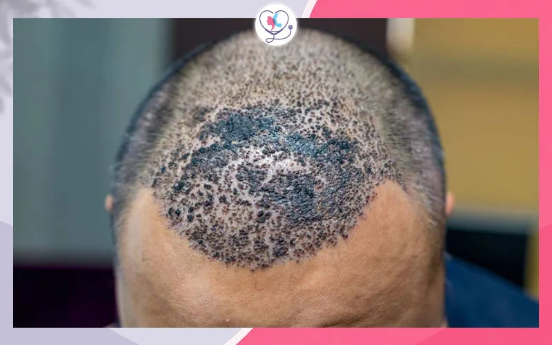 زراعة شعر فاشلة