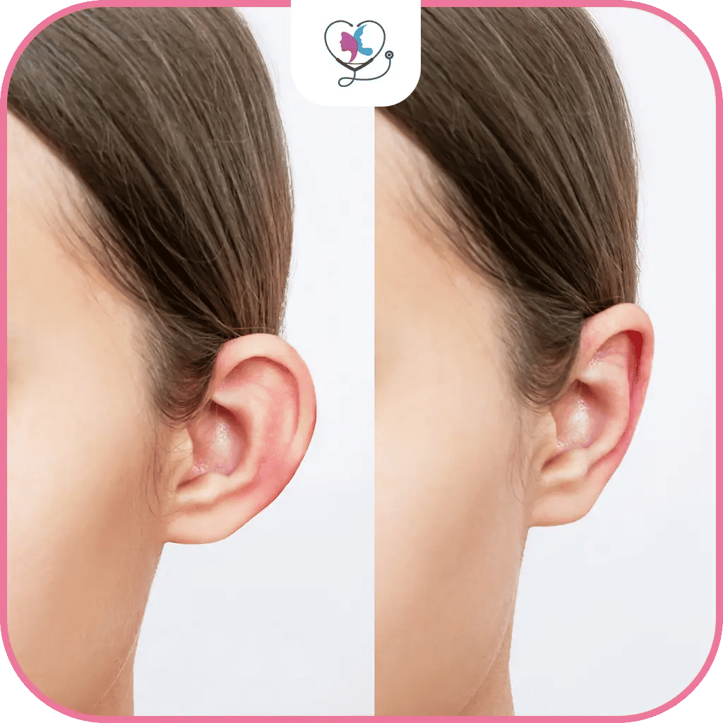 المرشحون لإجراء عملية تجميل الأذن في تركيا