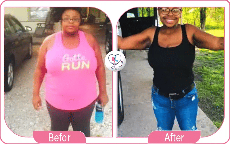 عيوب ومخاطر تجربتي مع بوتكس المعدة