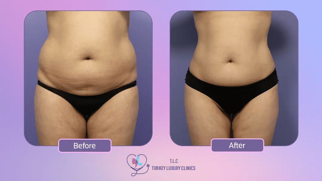 لماذا تختار تركيا لإجراء عملية نحت الجسم؟