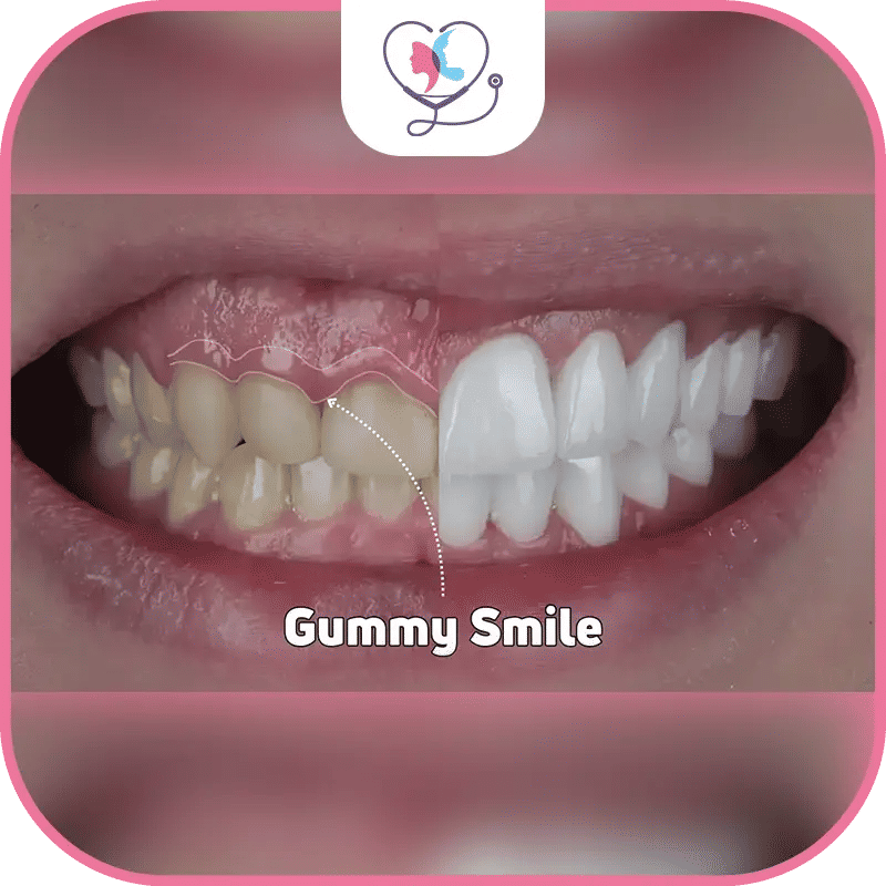 الابتسامة اللثوية