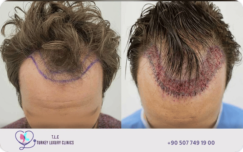 نصائح بعد زراعة الشعر بدون حلاقة نصائح بعد زراعة الشعر بدون حلاقة