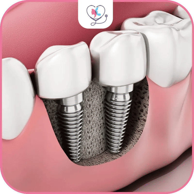 What are Dental Implants?