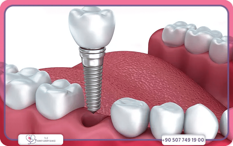 Combien de séances faut-il pour poser un implant dentaire ?