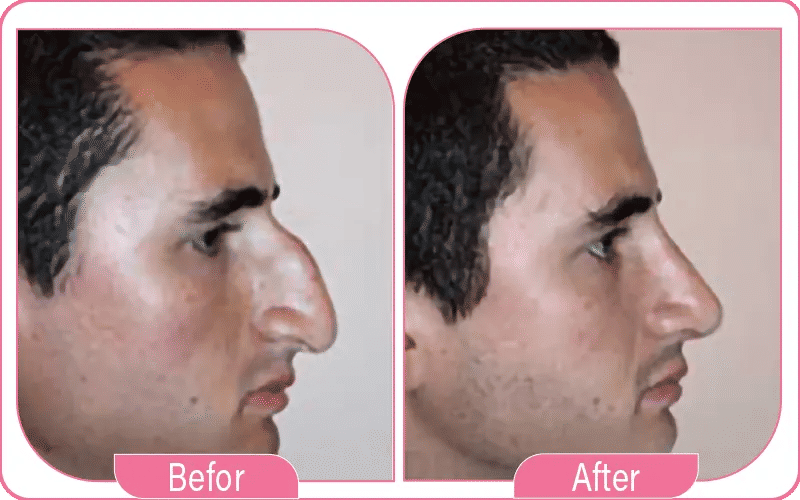 أنواع التشوهات حسب شكل الأنف ومكانه