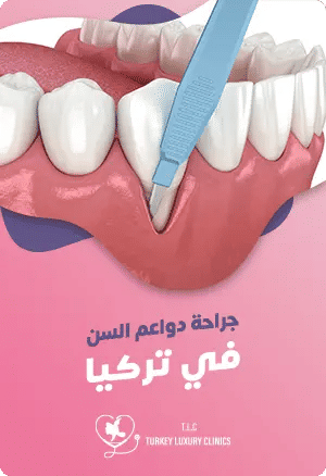 جراحة دواعم السن في تركياfeatured image