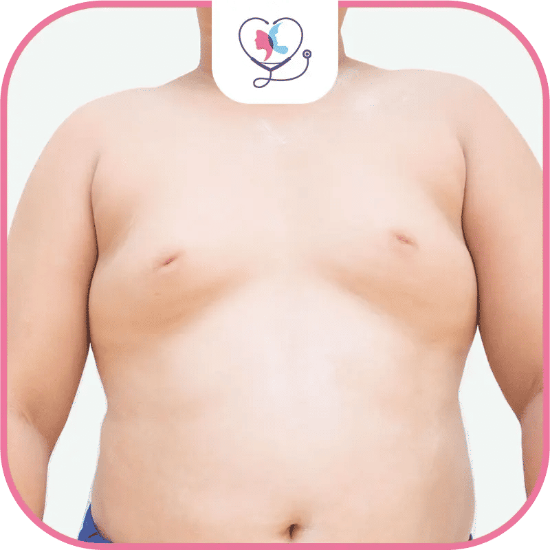  موانع عملية التثدي