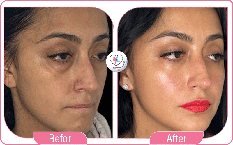 lipofilling visage avant et après-4