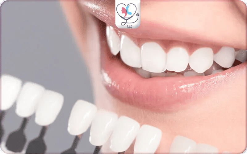 What are Dental Veneers?
